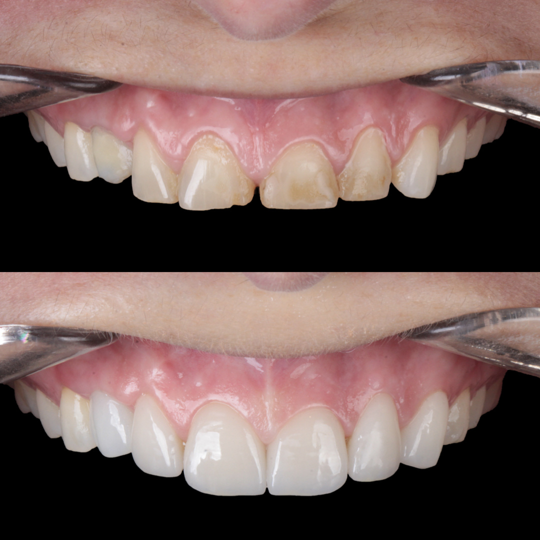 Caso de lente de contato dental — Clínica OdontoQueiroz, Niterói