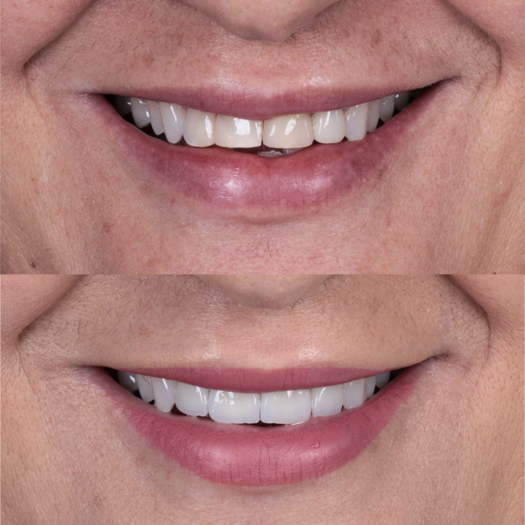 Caso de lente de contato dental — Clínica OdontoQueiroz, Niterói