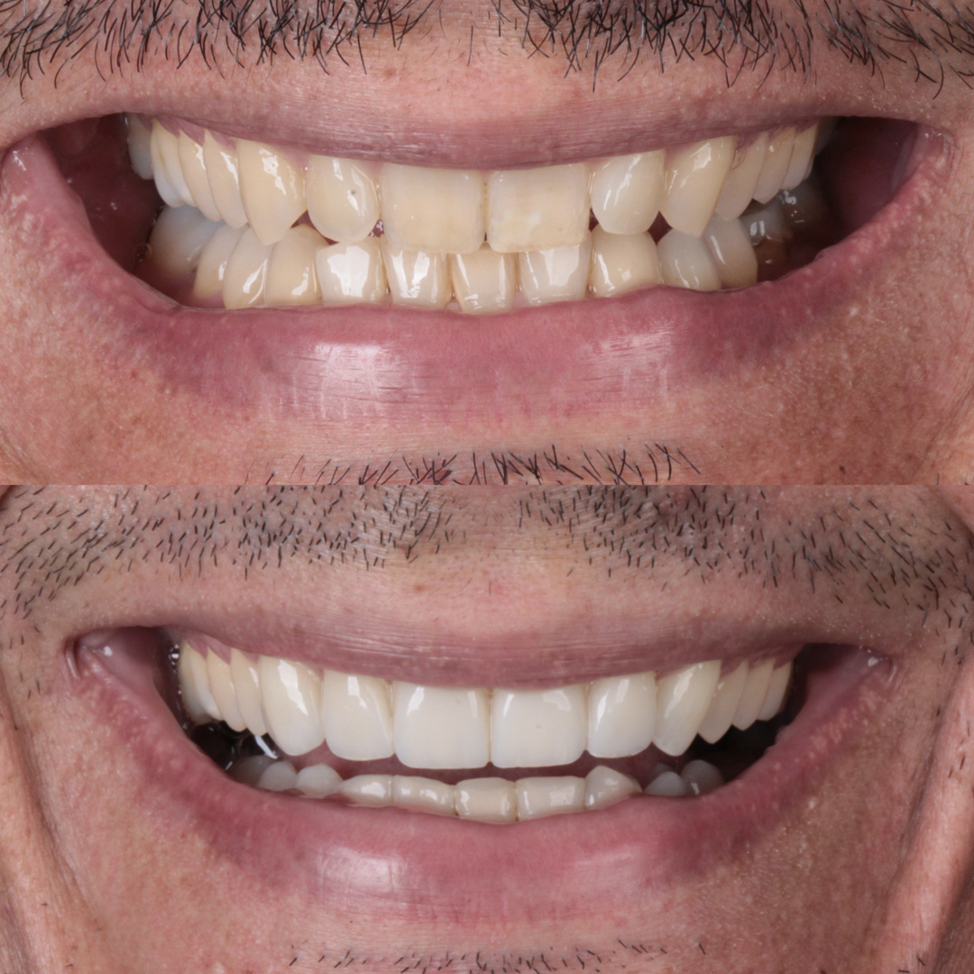 Caso de lente de contato dental — Clínica OdontoQueiroz, Niterói