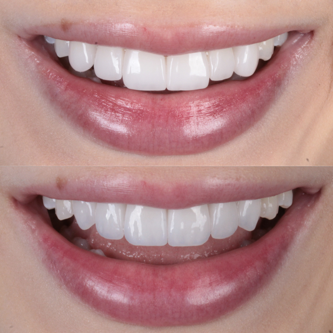 Caso de lente de contato dental — Clínica OdontoQueiroz, Niterói