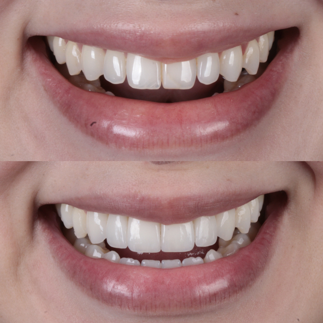 Caso de lente de contato dental — Clínica OdontoQueiroz, Niterói