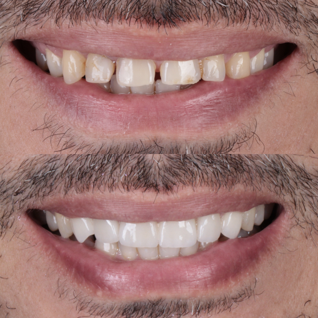 Caso de lente de contato dental — Clínica OdontoQueiroz, Niterói