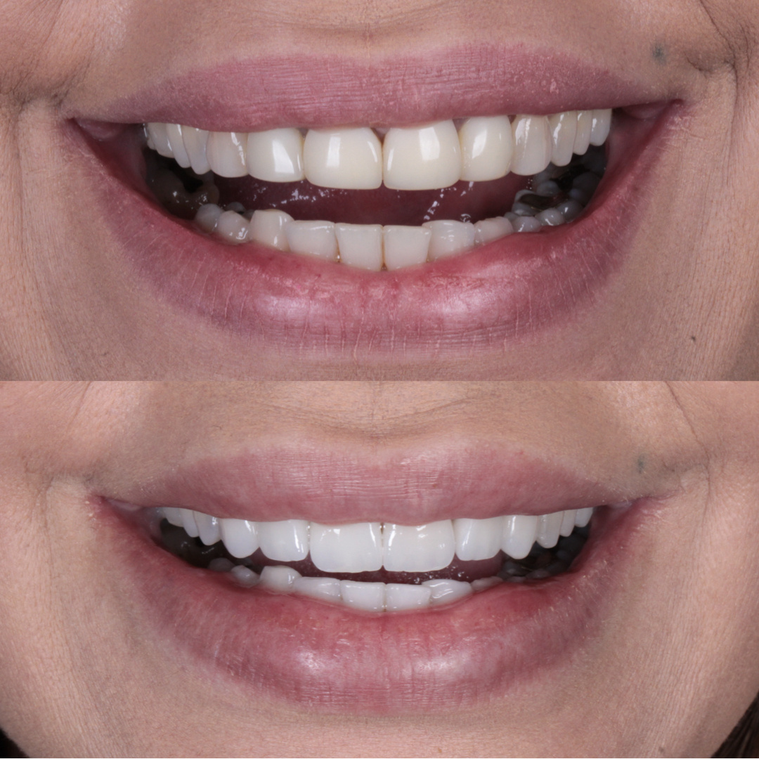 Caso de lente de contato dental — Clínica OdontoQueiroz, Niterói