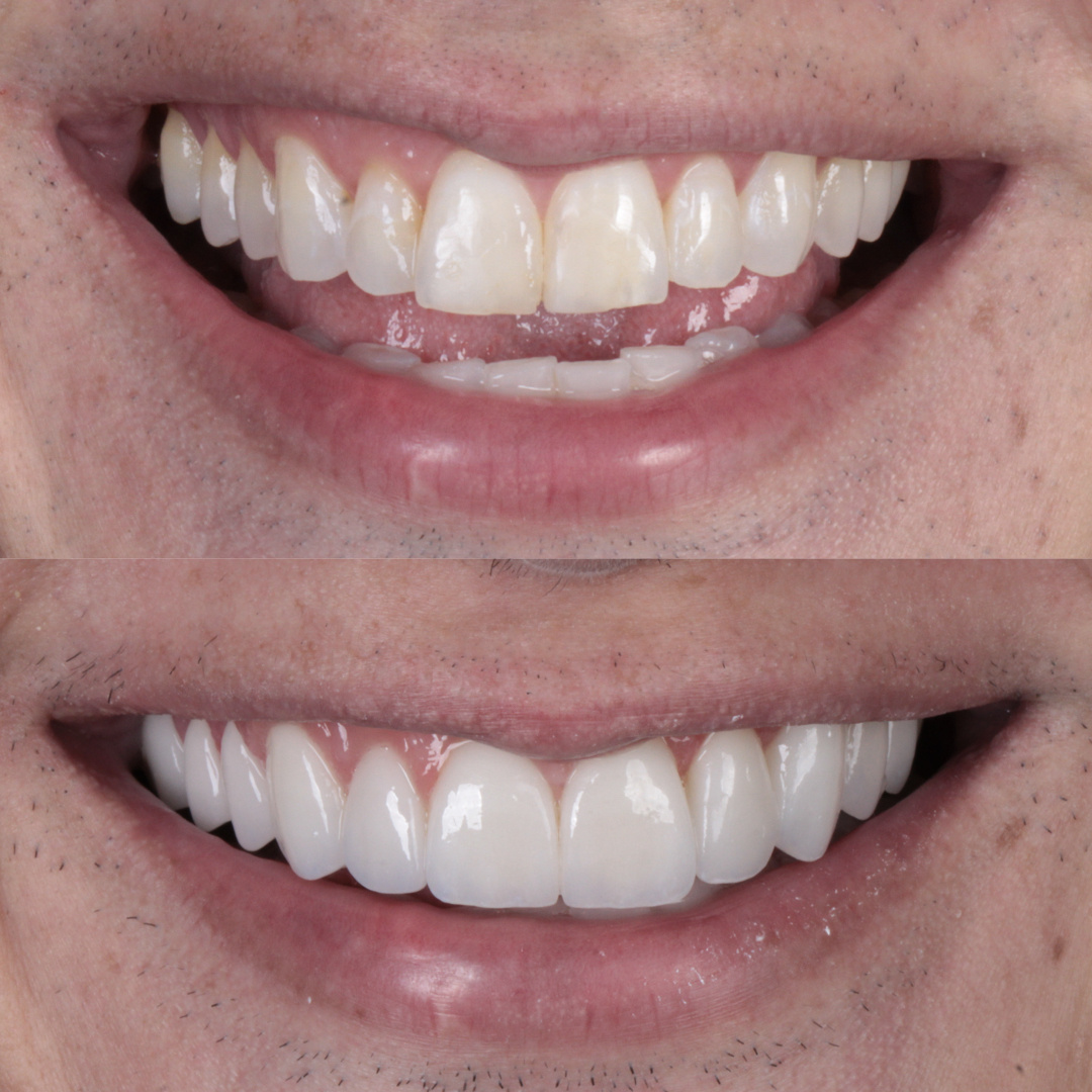 Caso de lente de contato dental — Clínica OdontoQueiroz, Niterói