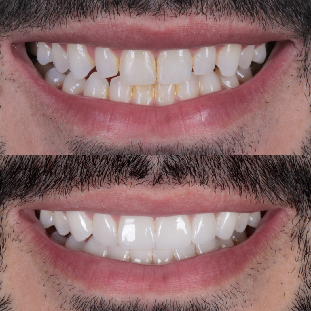 Caso de lente de contato dental — Clínica OdontoQueiroz, Niterói