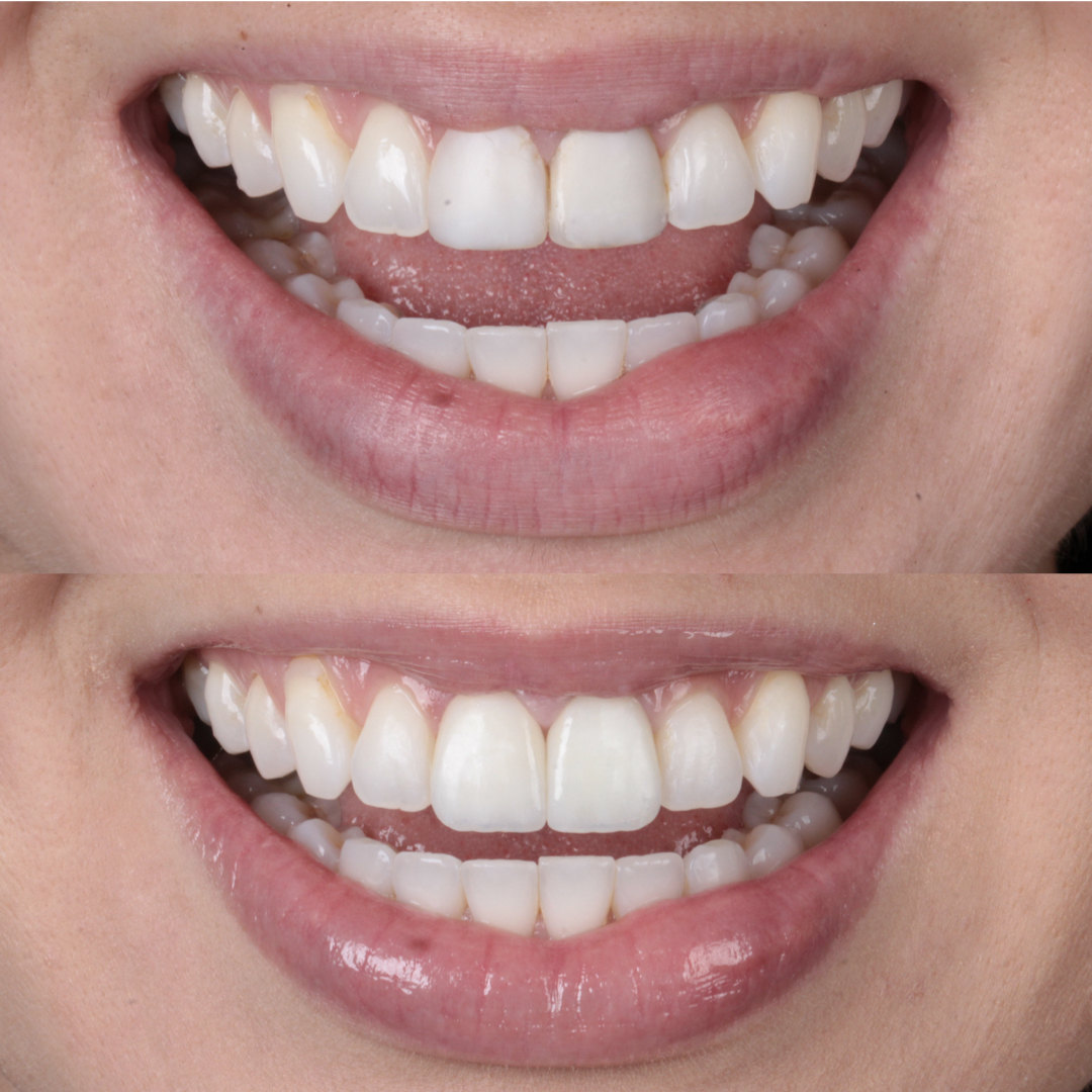 Transformação estética de sorriso em caso clínico odontológico