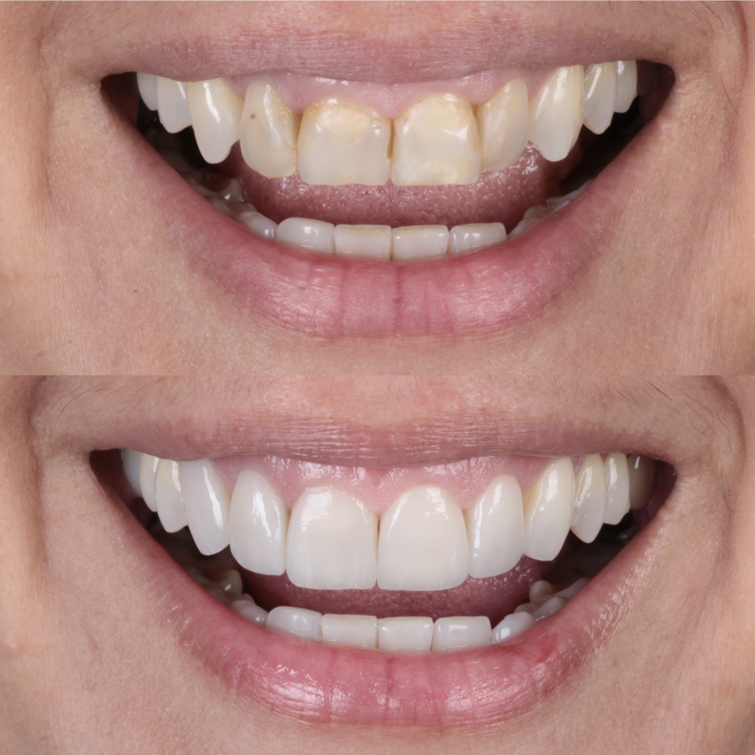 Antes e depois de caso clínico odontológico na Clínica OdontoQueiroz
