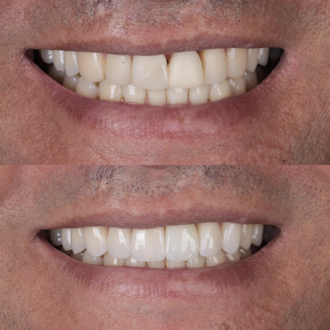 Antes e depois de transformação de sorriso na Clínica OdontoQueiroz