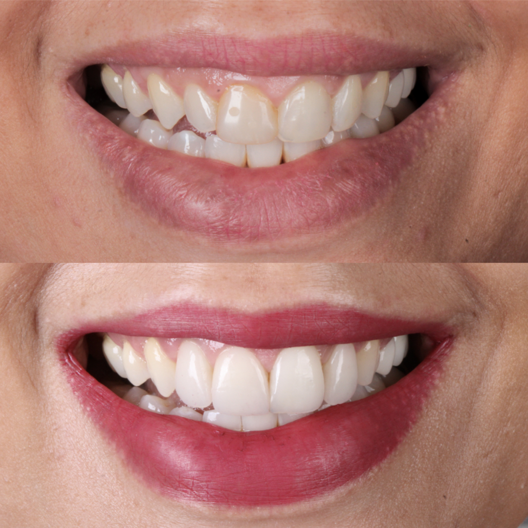 Antes e depois de sorriso tratado na Clínica OdontoQueiroz
