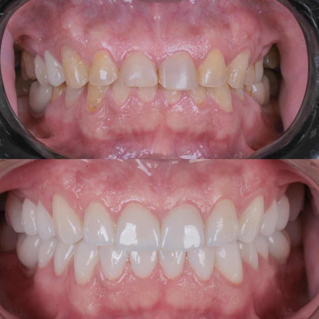 Vista clínica de antes e depois de tratamento odontológico