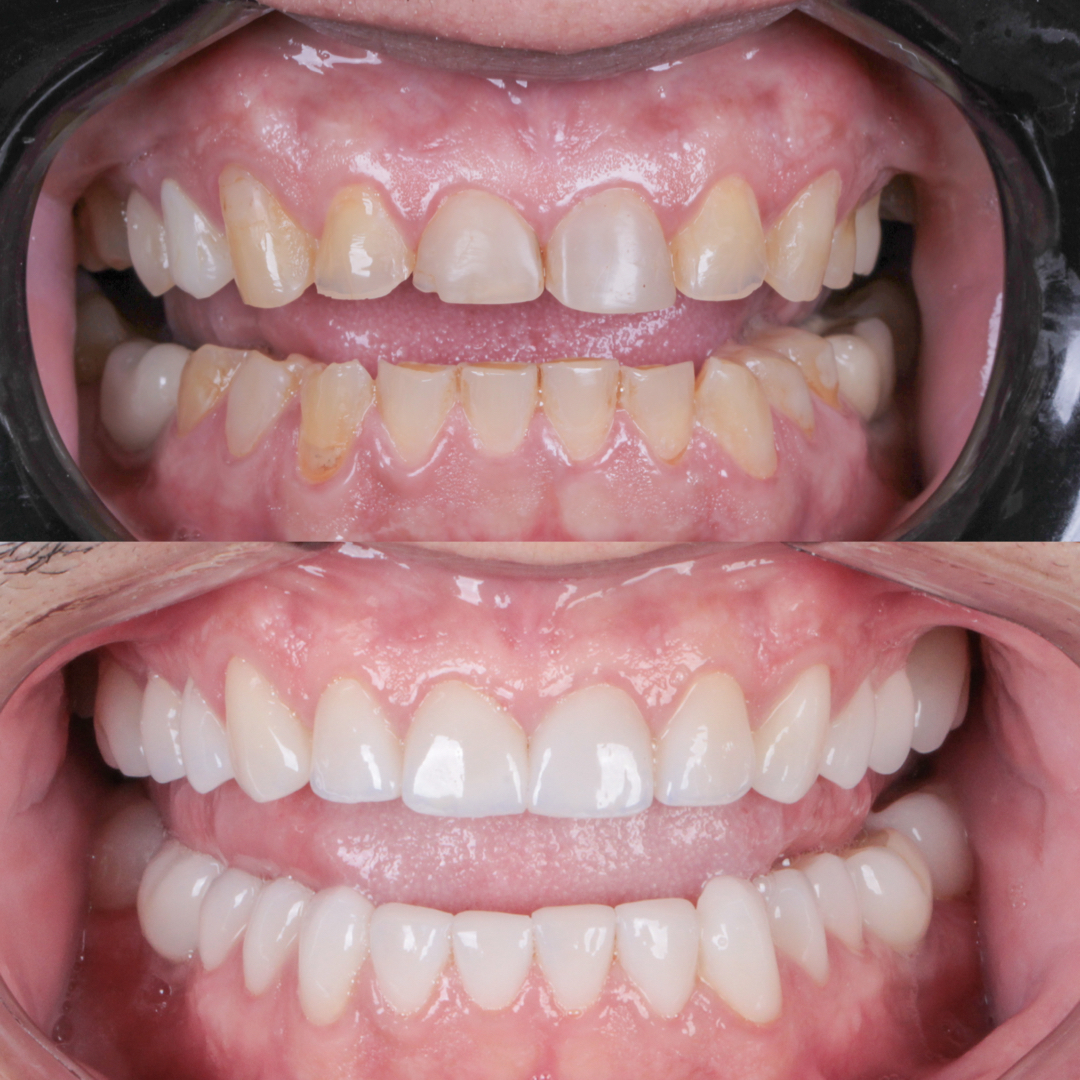 Resultado clínico de transformação odontológica do sorriso