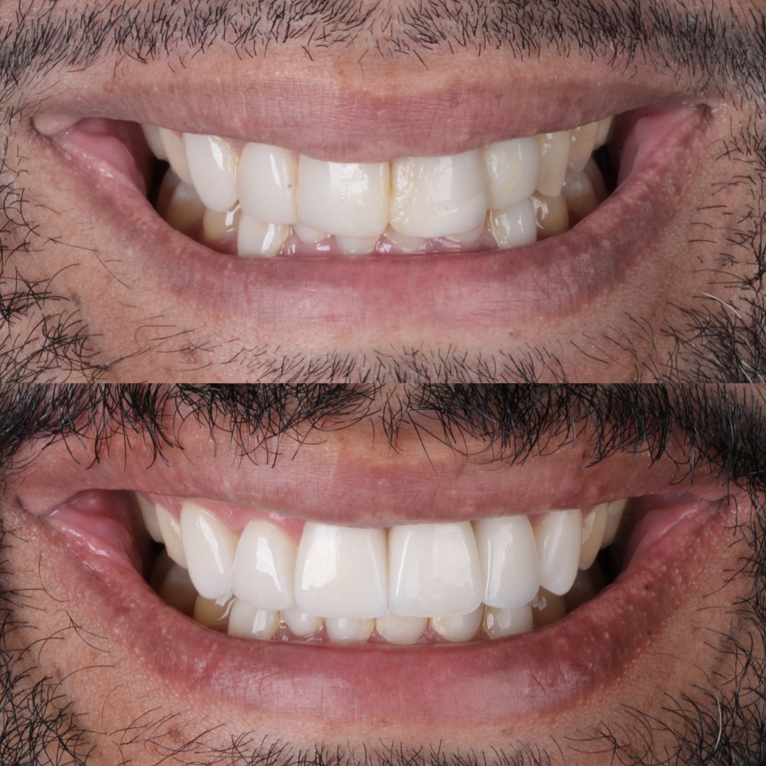 Caso clínico de transformação do sorriso na Clínica OdontoQueiroz