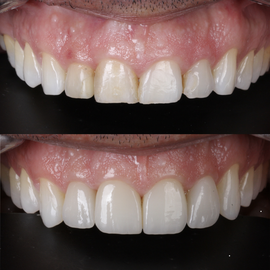Detalhe de antes e depois de caso clínico odontológico