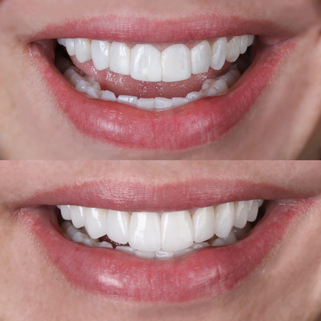 Resultado de transformação estética do sorriso na Clínica OdontoQueiroz