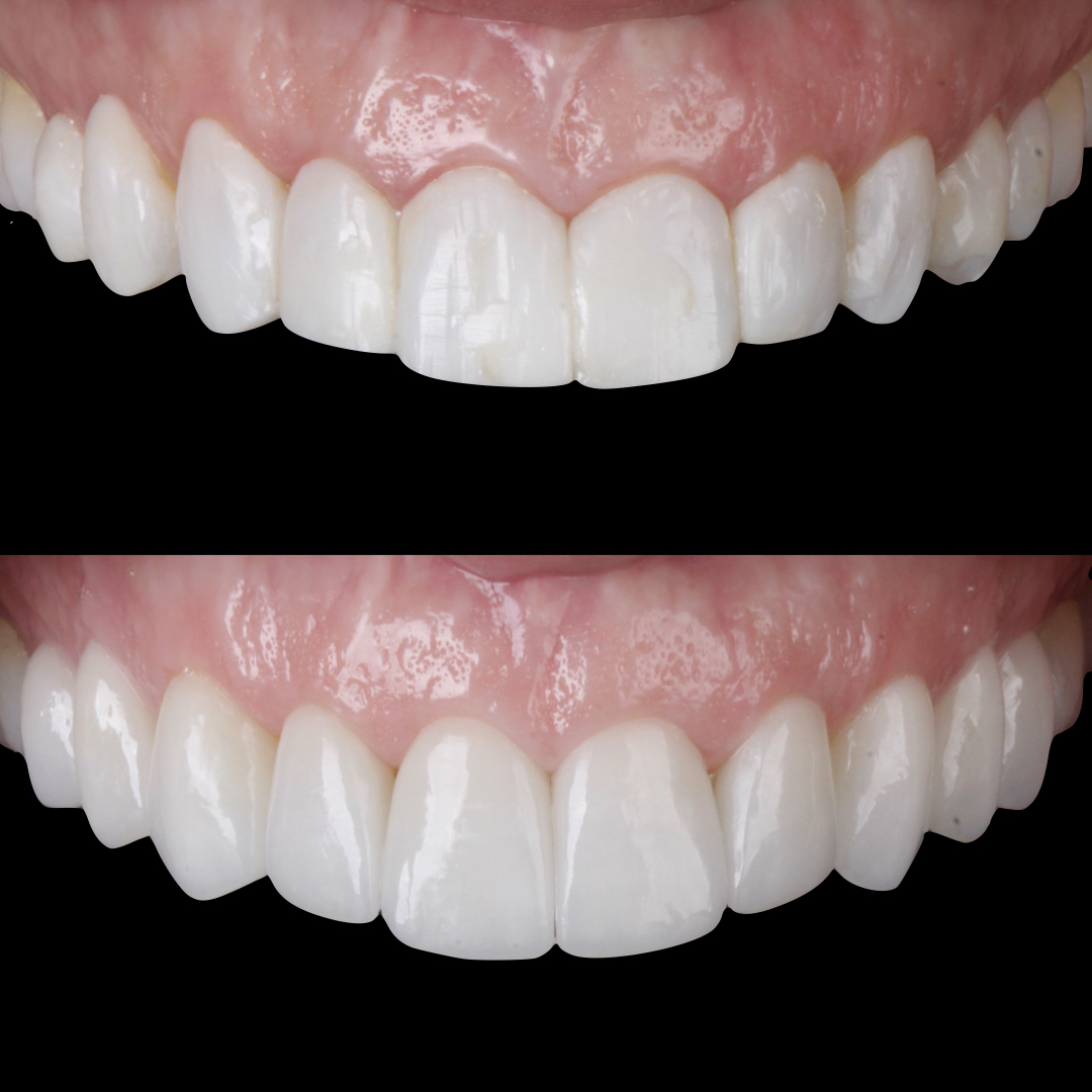 Detalhe de resultado estético do sorriso na Clínica OdontoQueiroz
